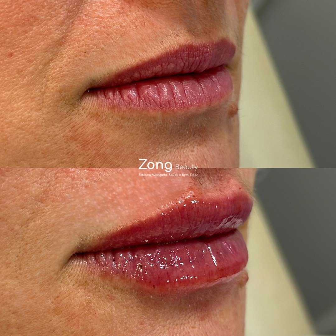 Antes e Depois - Harmonização Facial