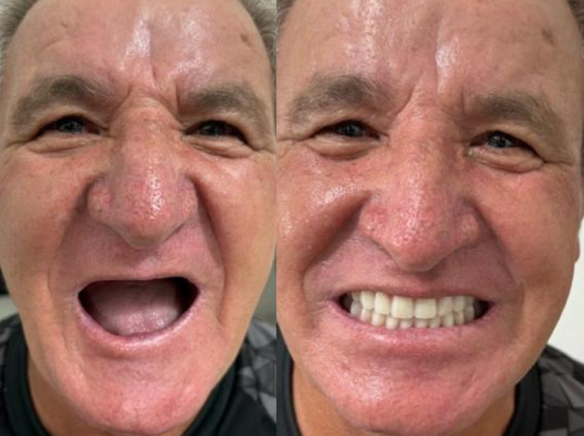 Antes e depois — paciente Carvalho Odontologia