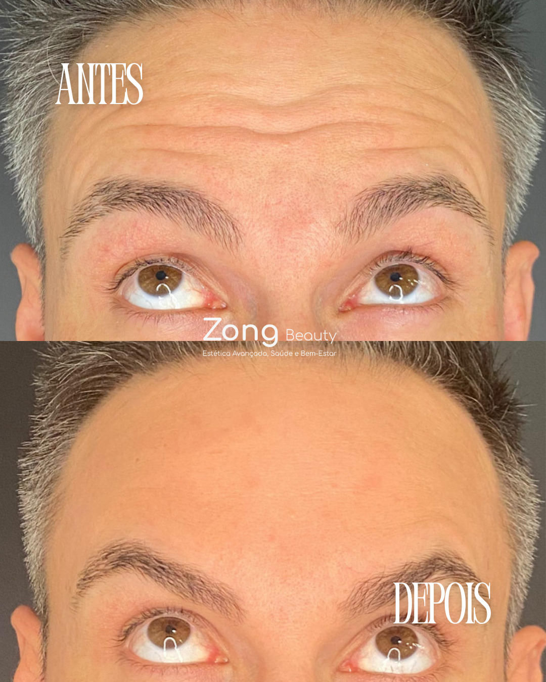 Antes e Depois - Tratamento Estético
