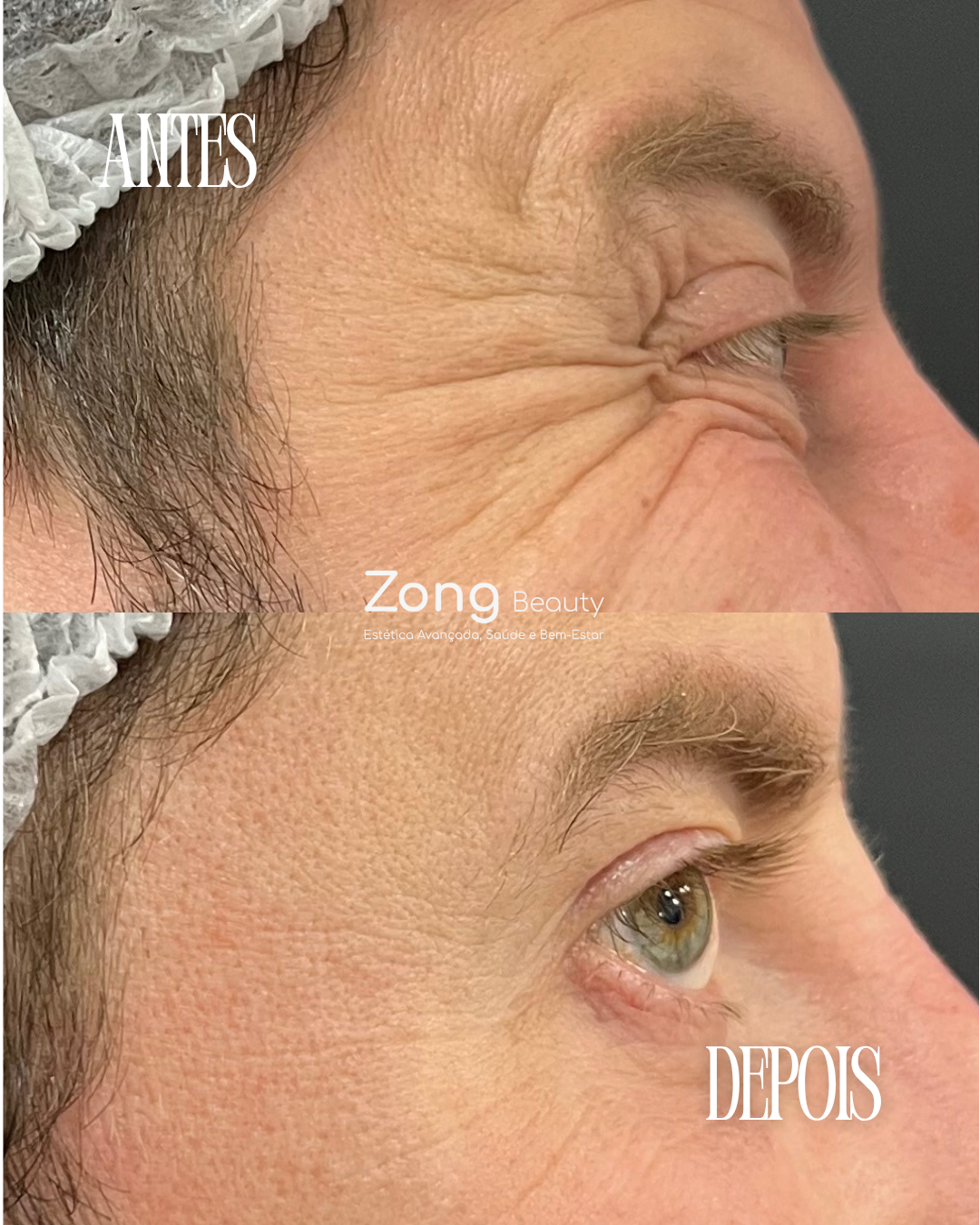 Antes e Depois - Tratamento Estético