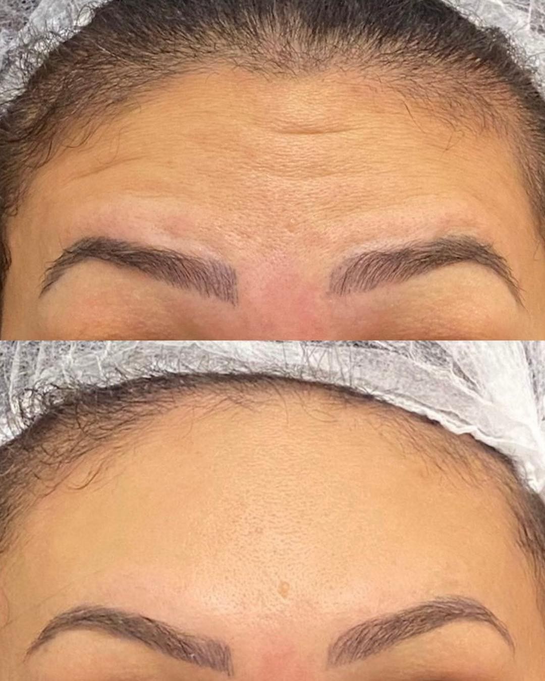 Antes e Depois - Harmonização Facial