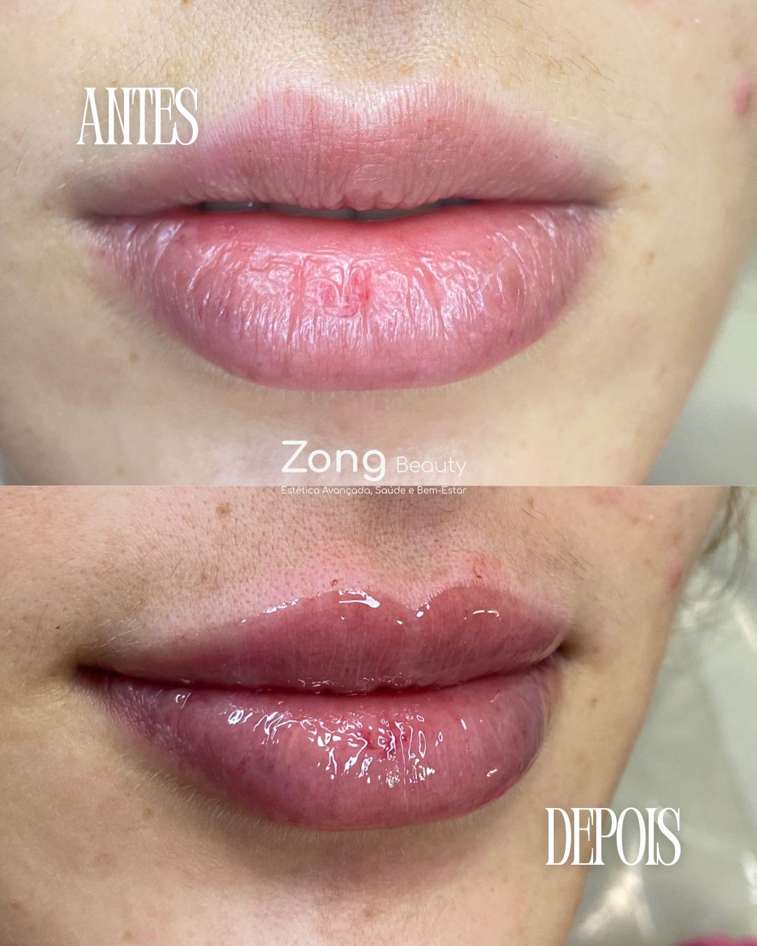 Antes e Depois - Tratamento Estético
