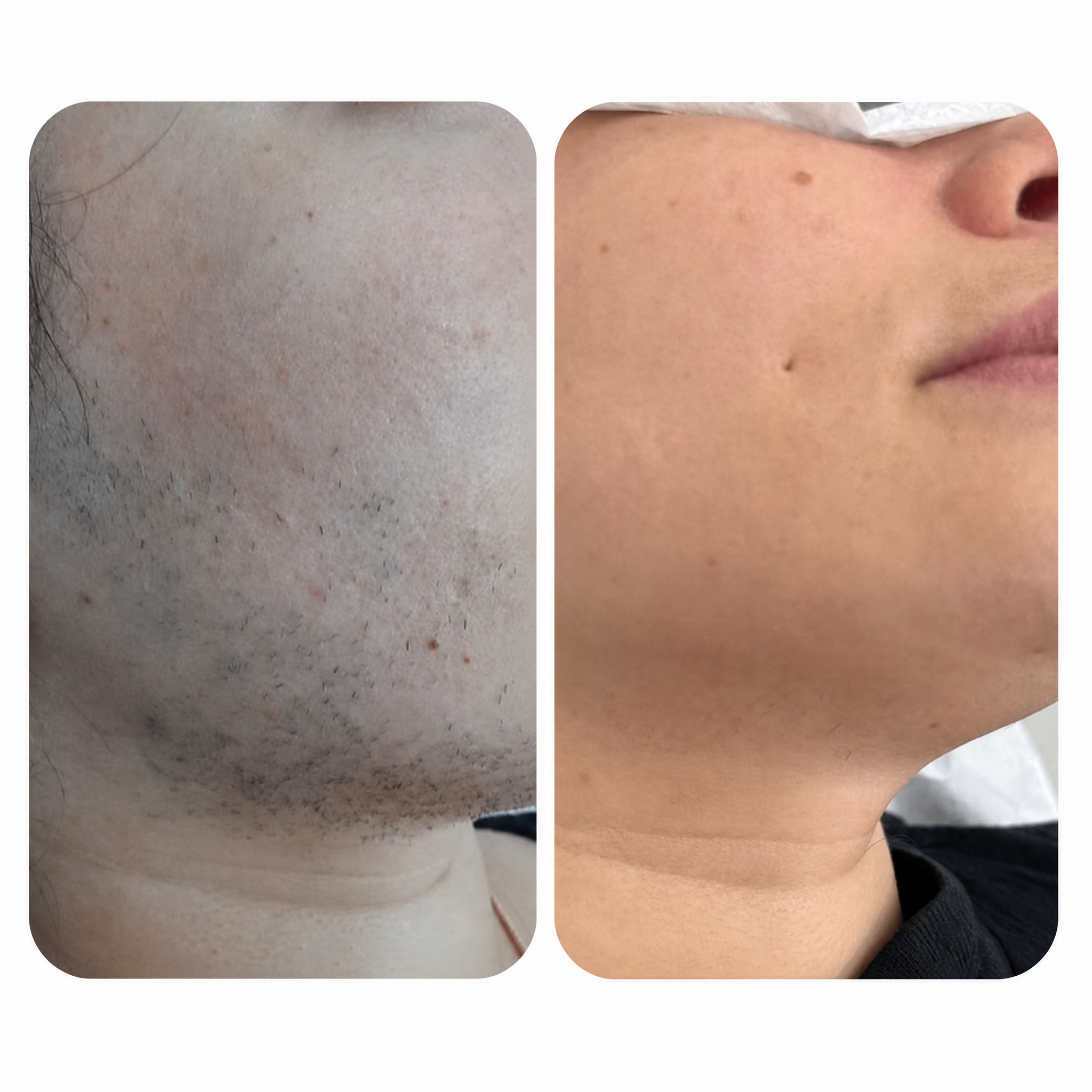 Antes e depois - buço
