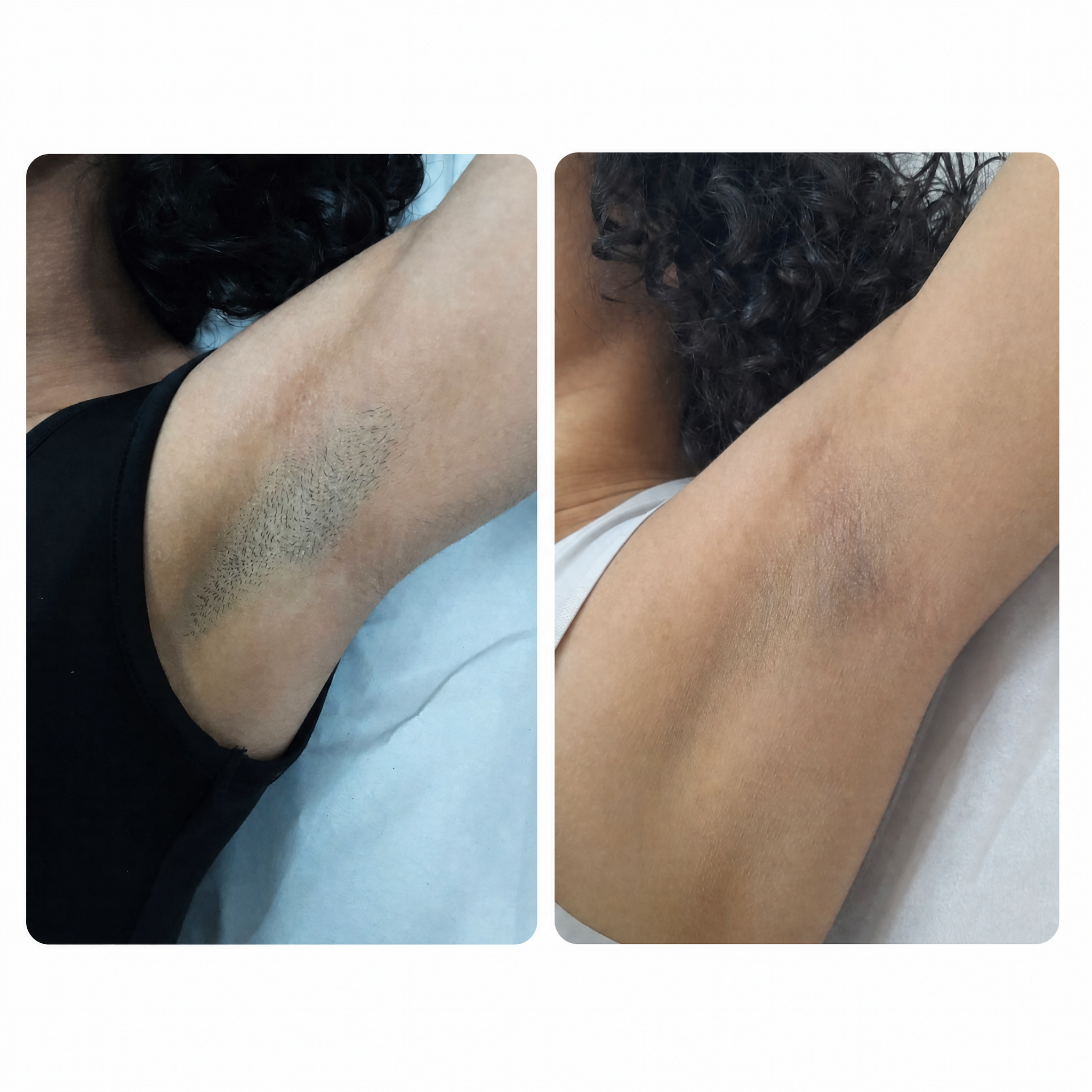 Antes e depois - axilas