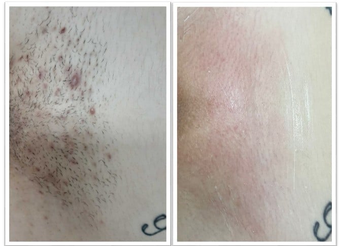 Antes e depois - virilha