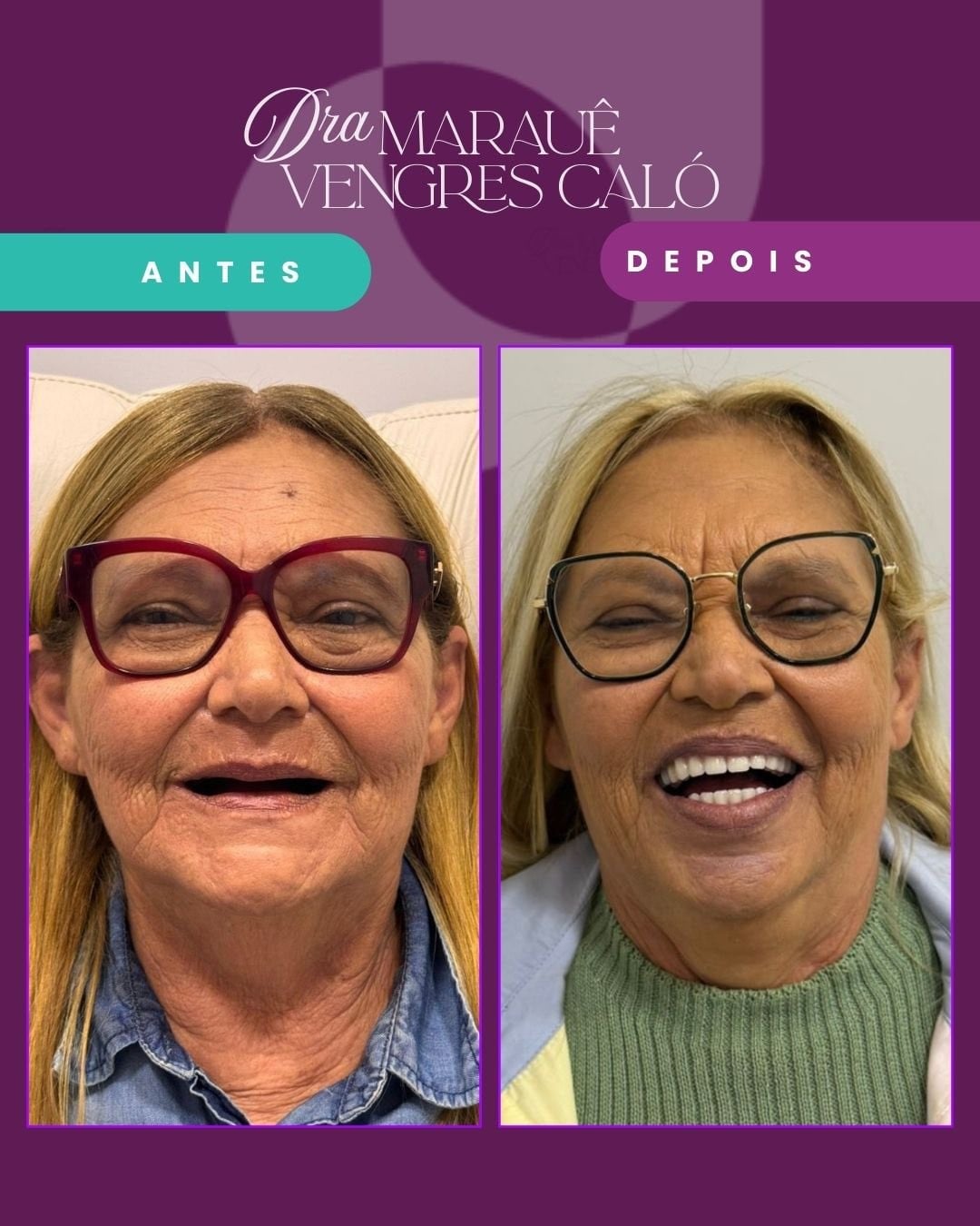 Resultado de Implante 2