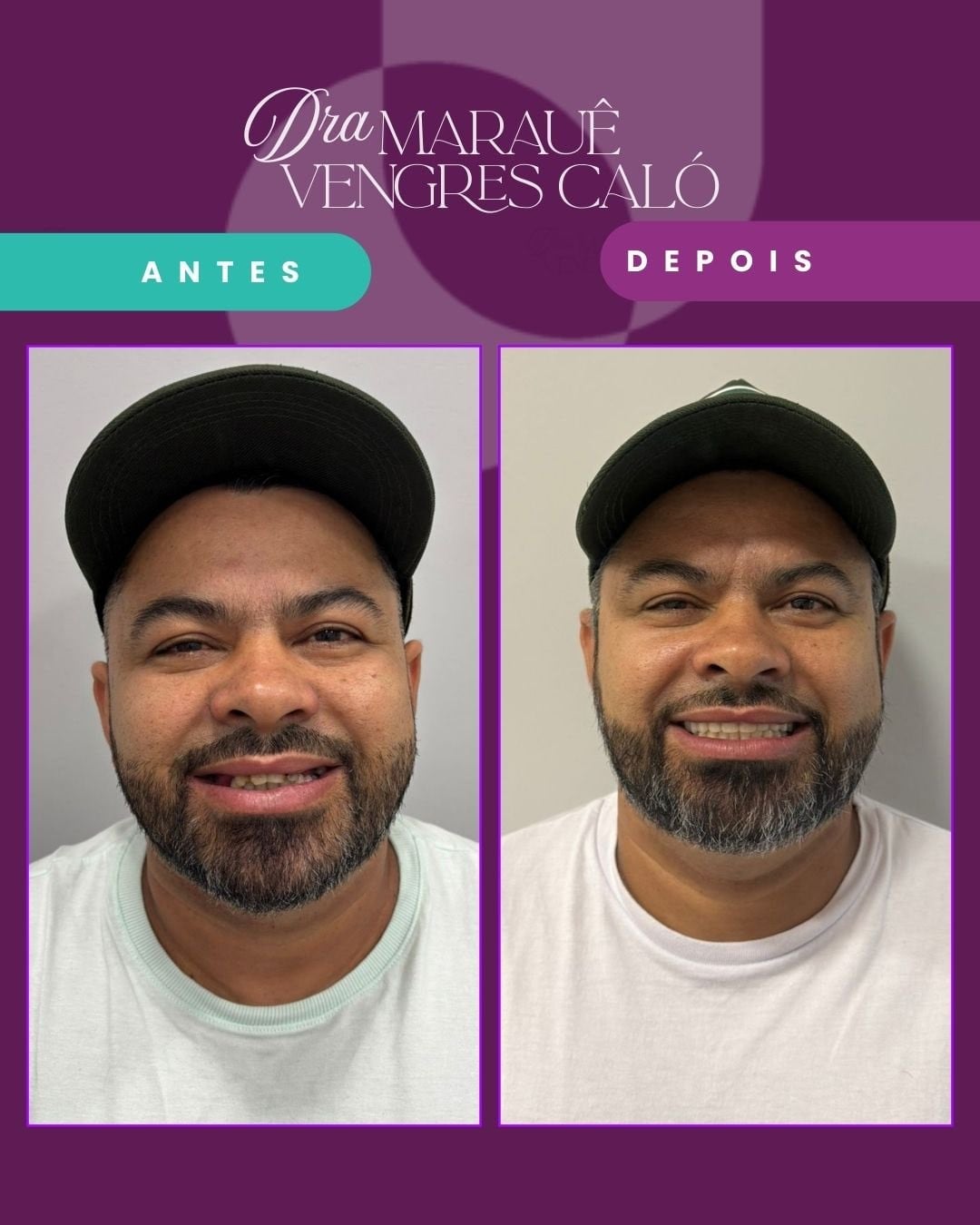 Resultado de Implante 1