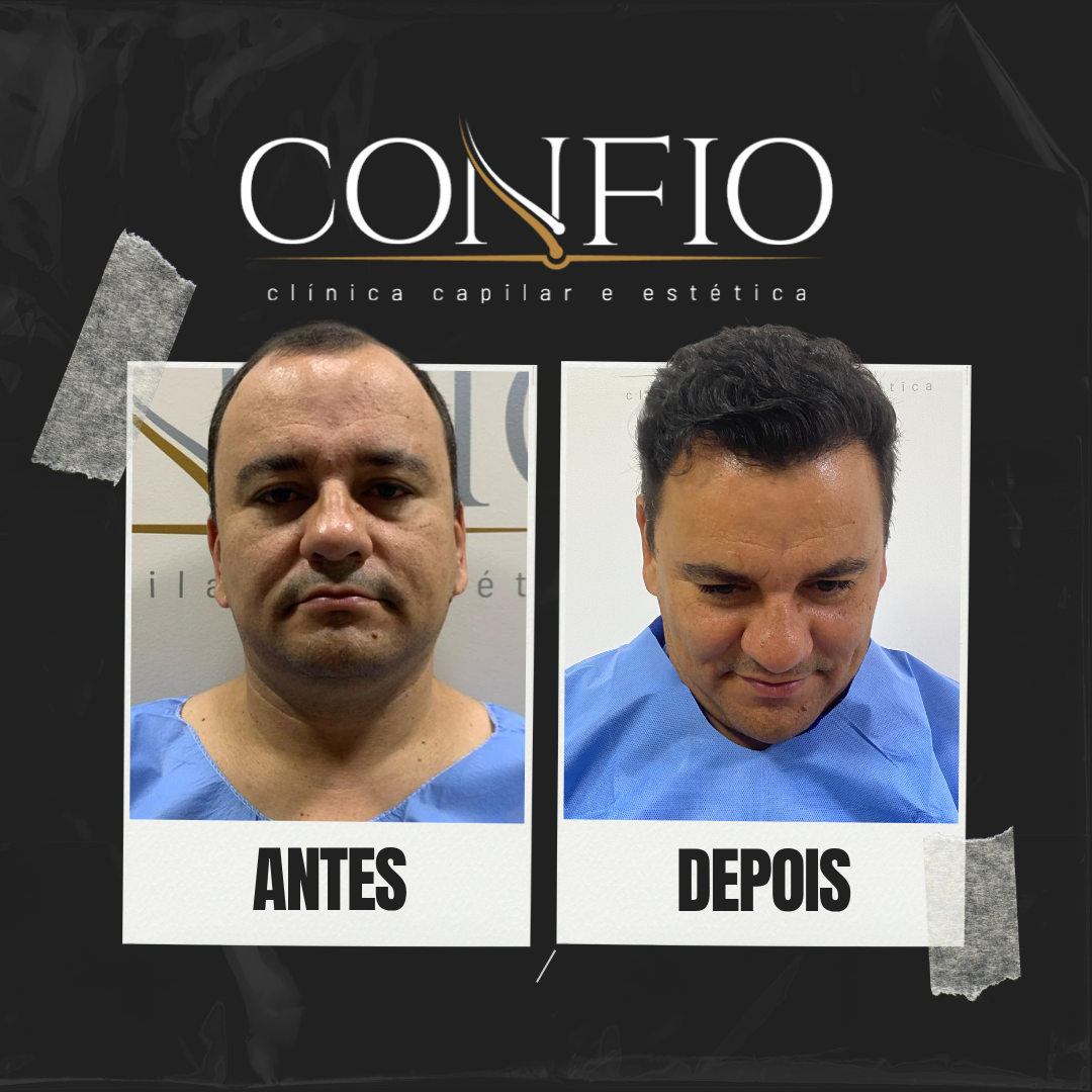 Antes e depois 2
