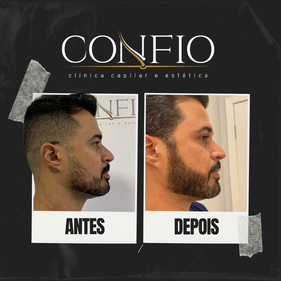 Antes e depois 4