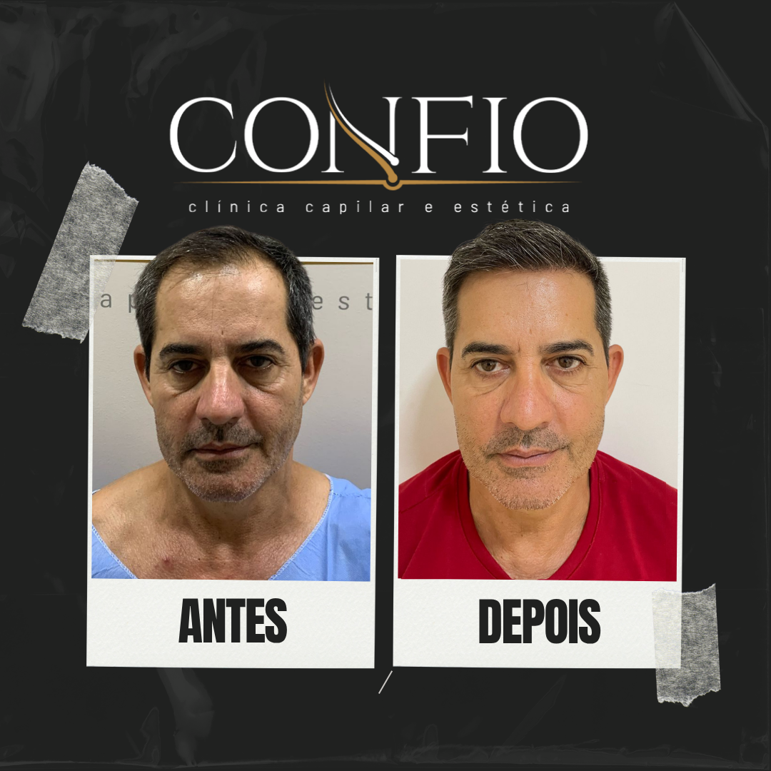 Antes e depois 3