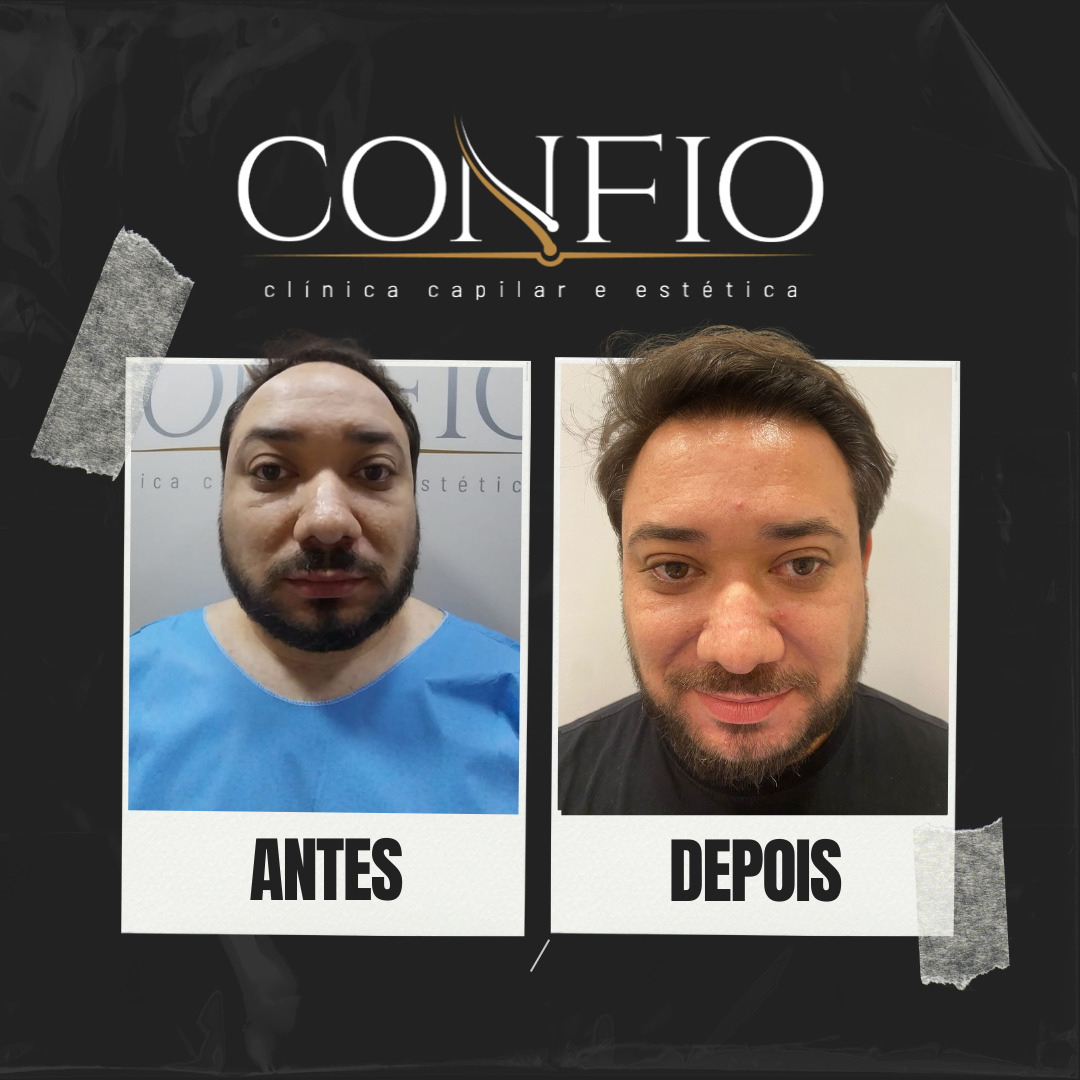 Antes e depois 1