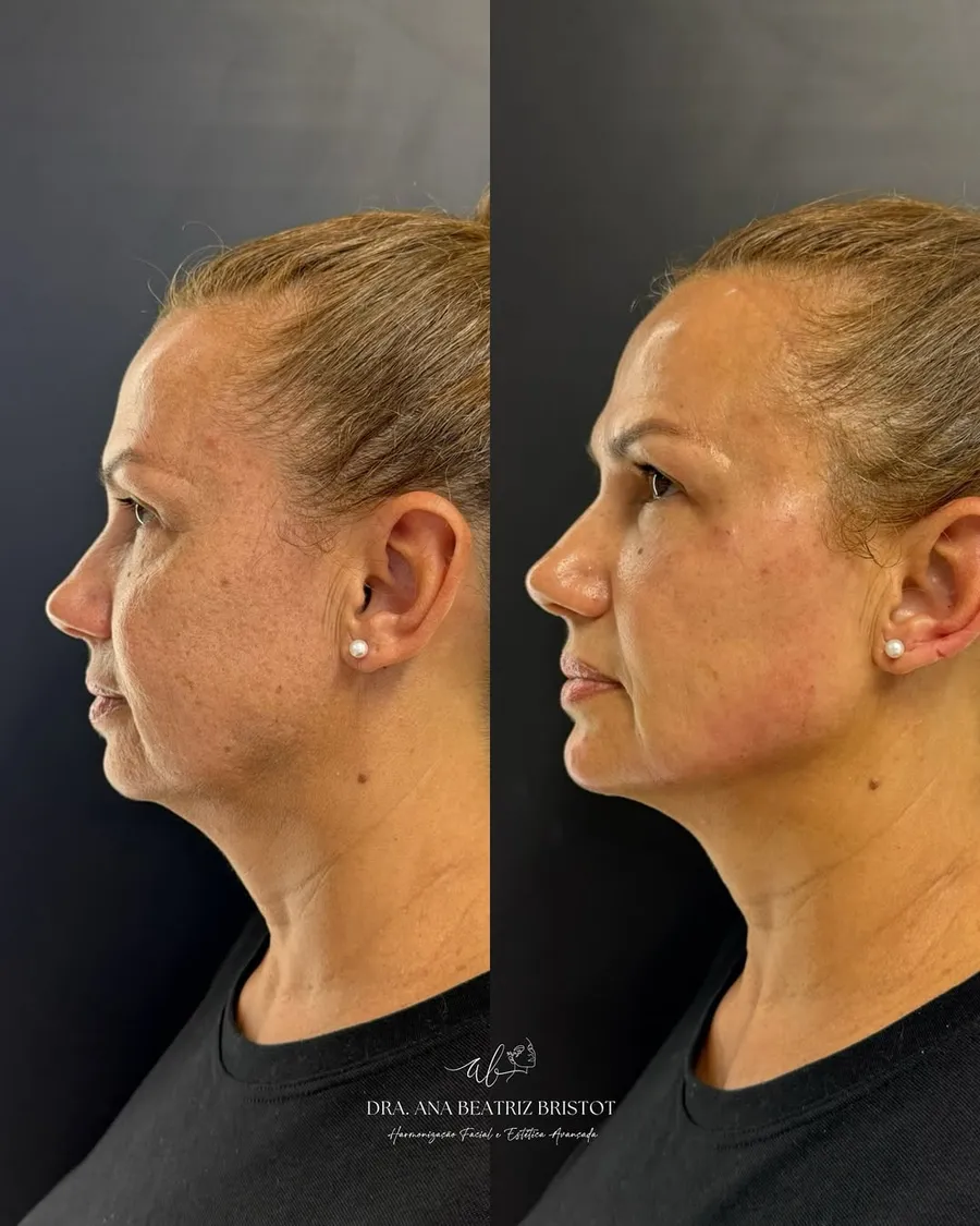 Antes e depois de contorno facial — perfil lateral