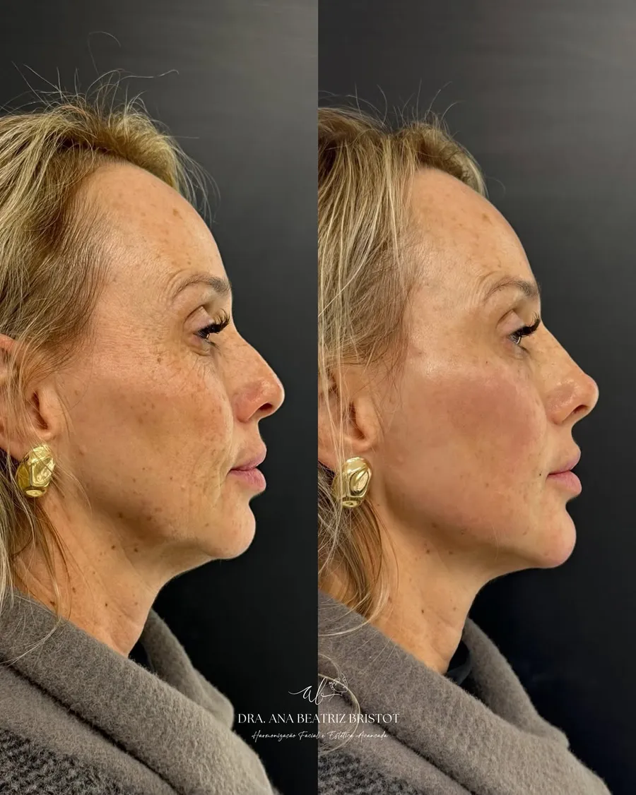 Antes e depois de rejuvenescimento facial — perfil