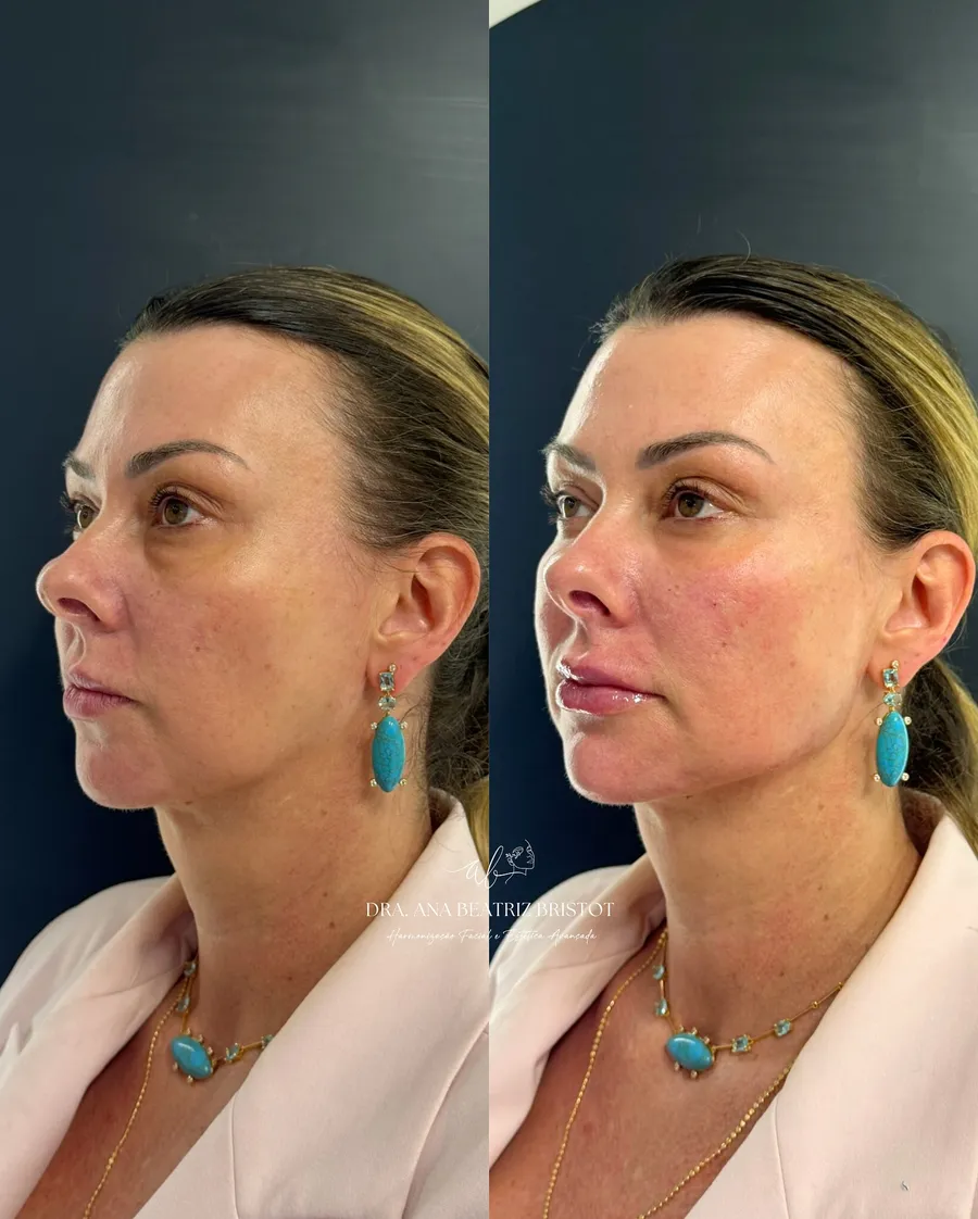 Antes e depois de harmonização facial — perfil três quartos