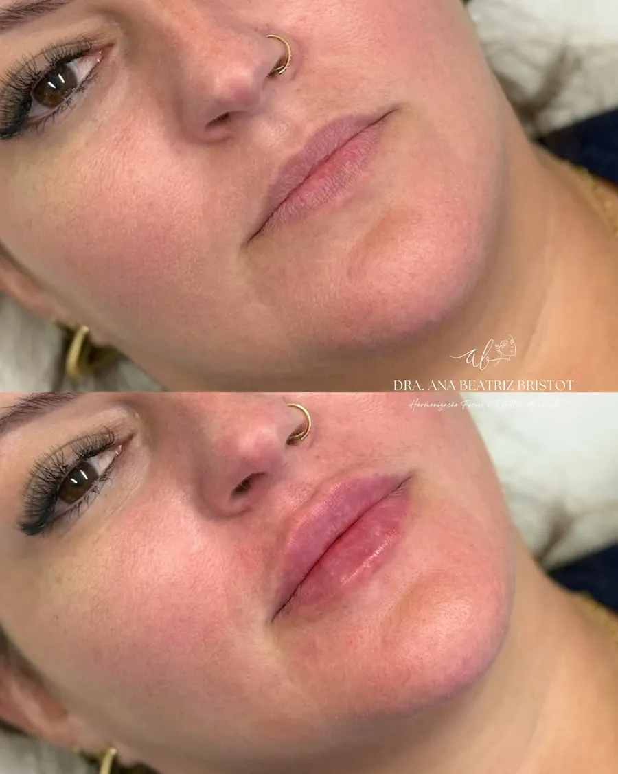 Antes e depois de preenchimento labial em close