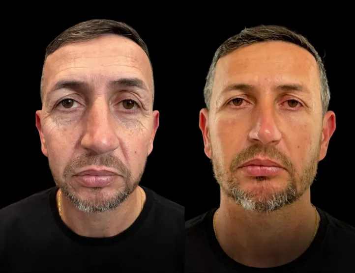 Antes e depois de harmonização facial masculina — vista frontal