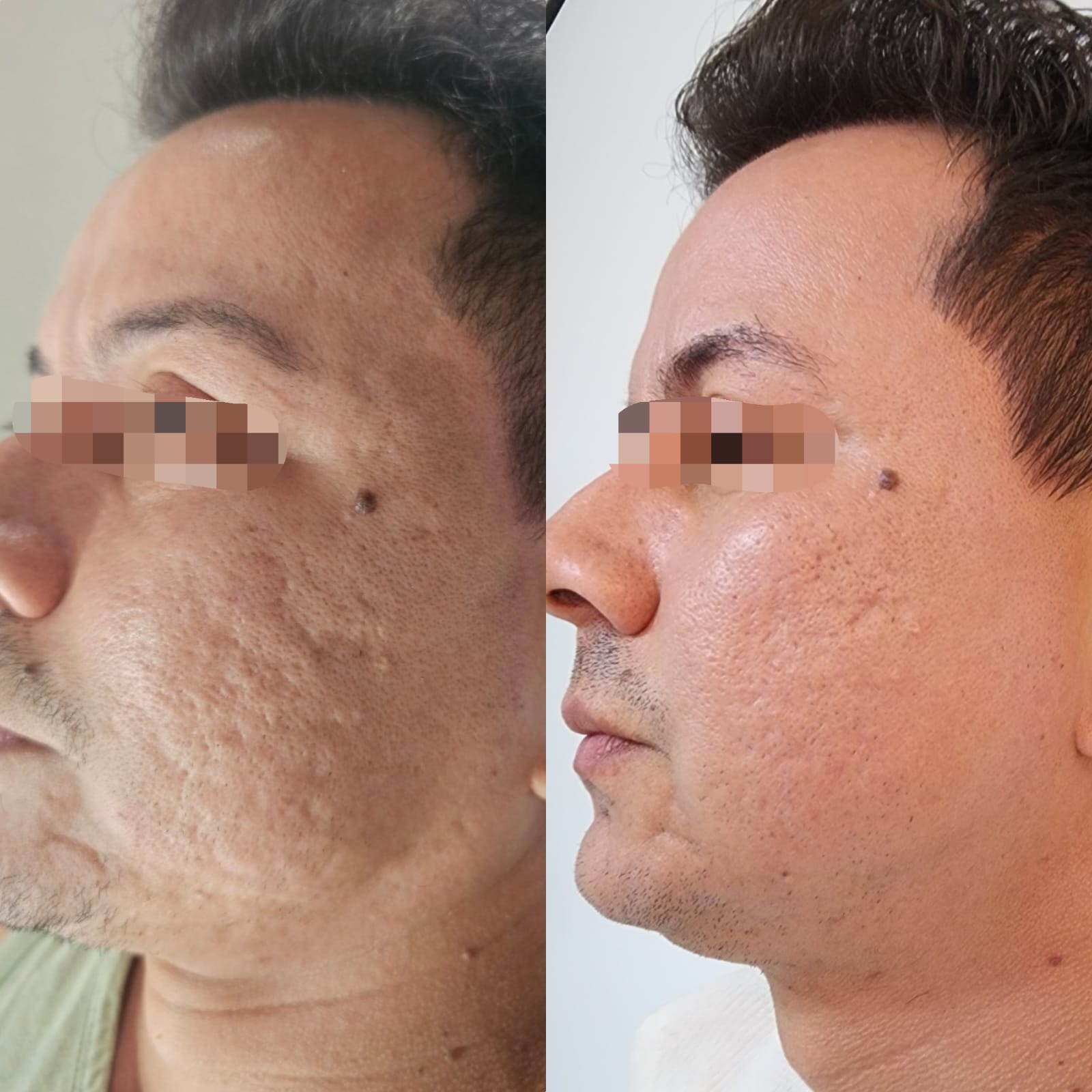 Comparativo facial masculino fornecido, com registros anterior e posterior lado a lado.