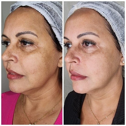 Comparativo facial fornecido: registro anterior à esquerda e posterior à direita.