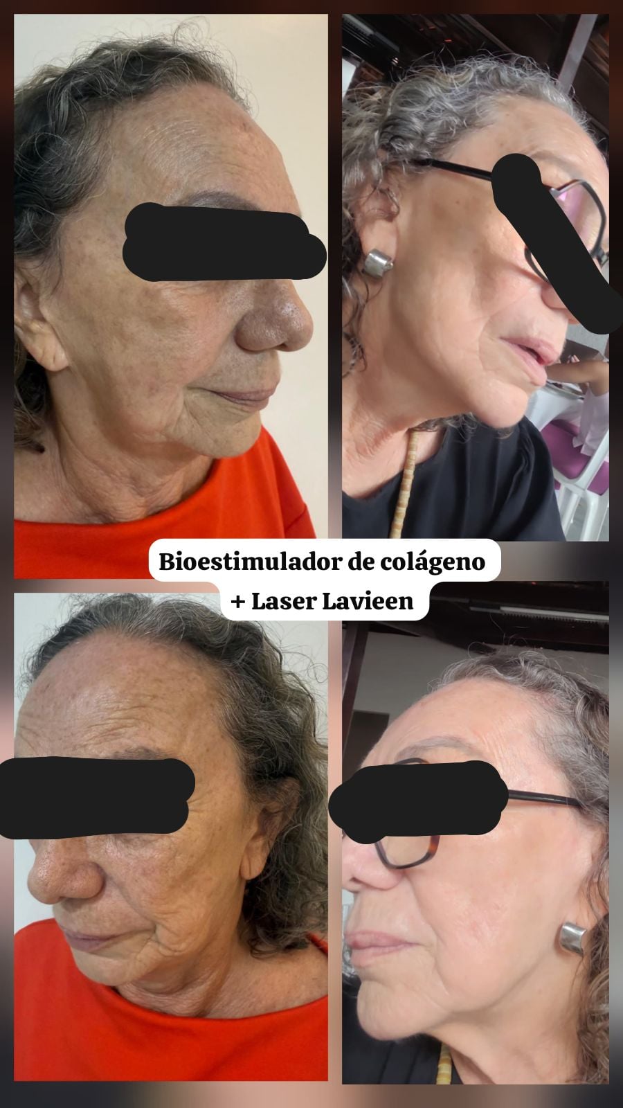 Montagem identificada como Bioestimulador de colágeno + Laser Lavieen. O bioestimulador não faz parte deste combo.