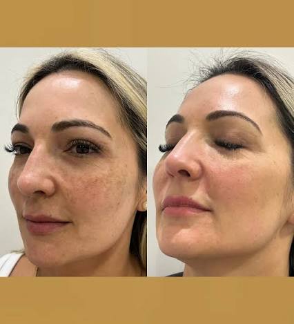 Imagem de antes e depois facial fornecida para a página, preservada na íntegra.