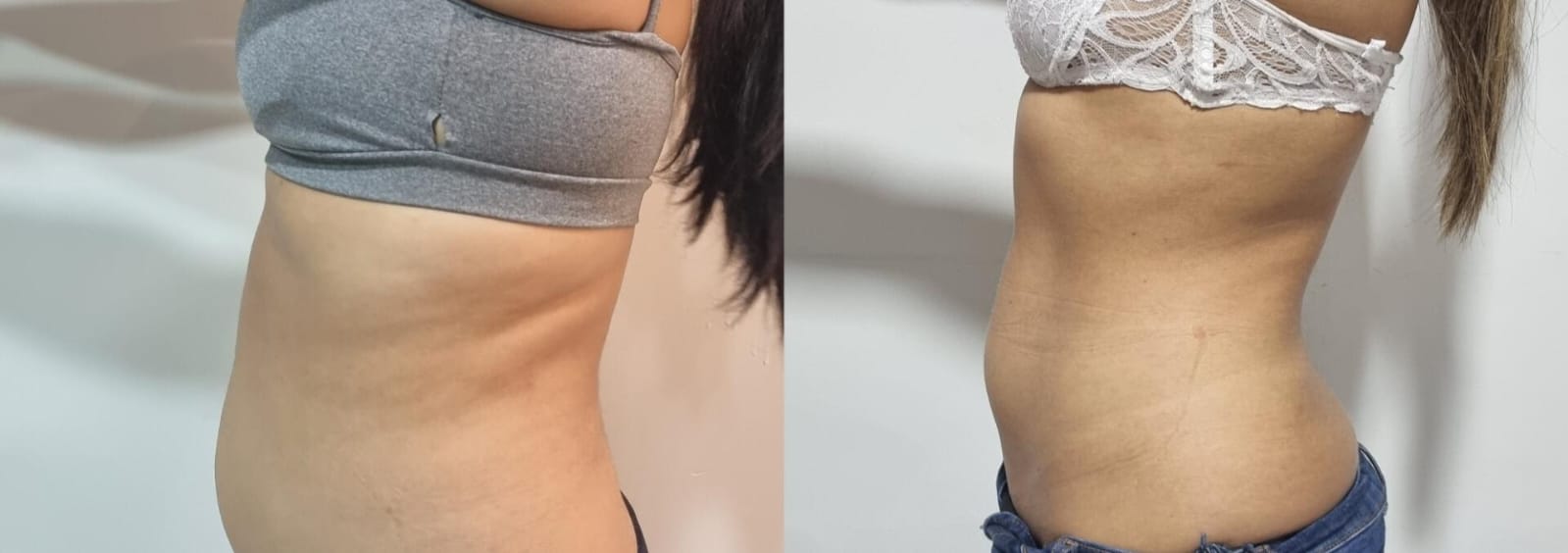 Contorno corporal · comparativo lateral, imagem enviada pela Empoderada Estética