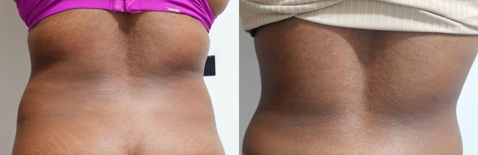 Antes e depois do contorno corporal: vista posterior, registro enviado pela clínica