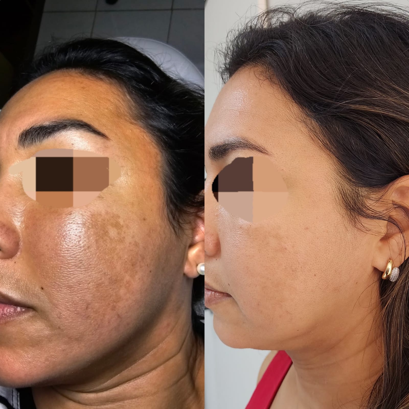 Comparativo facial enviado pela clínica, com o registro anterior à esquerda e posterior à direita