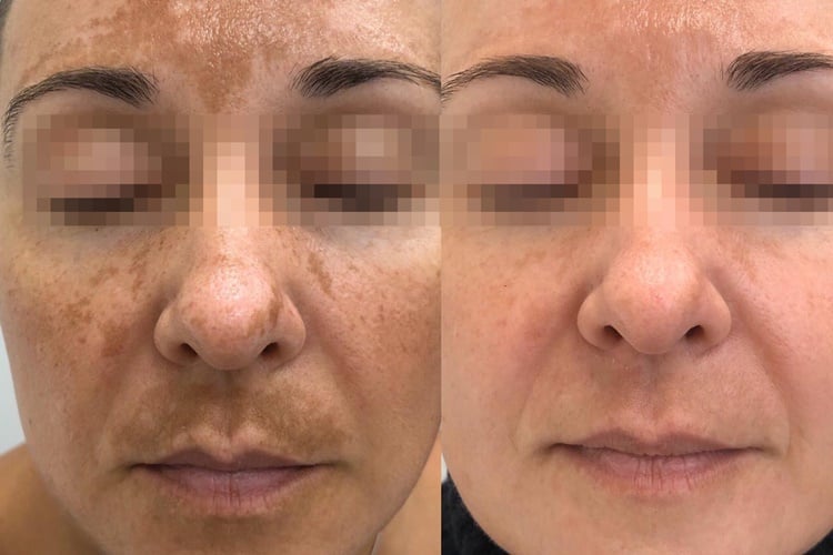 Comparativo frontal facial fornecido, com olhos protegidos; resultados individuais.