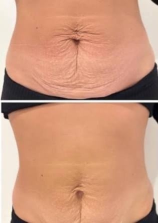 Abdômen · comparativo vertical, imagem enviada pela Empoderada Estética
