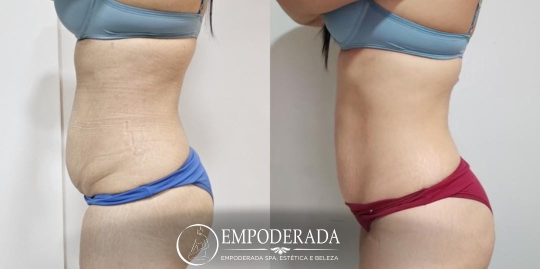 Comparativo corporal enviado pela Empoderada Estética: antes à esquerda e depois à direita