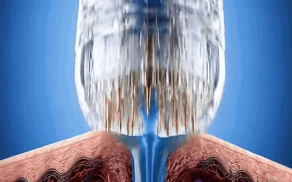 Sérum azul descendo pelos microcanais até a raiz