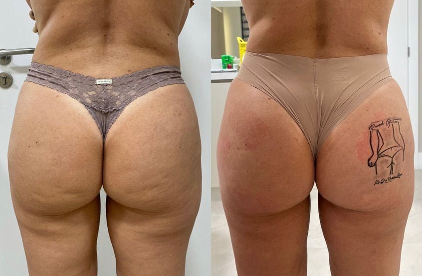Antes e depois — Celulite e textura