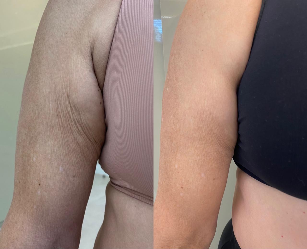Antes e depois — Braços — textura