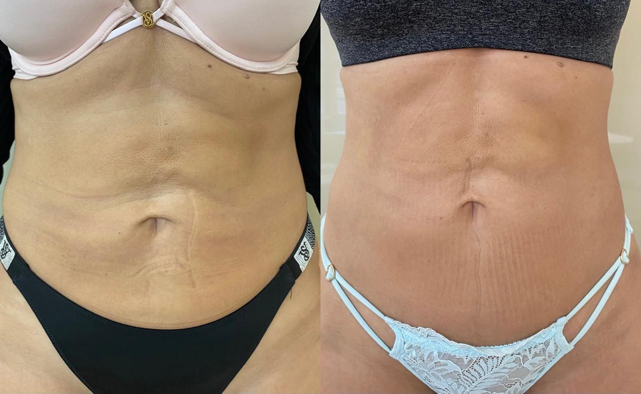 Antes e depois — Abdômen e firmeza
