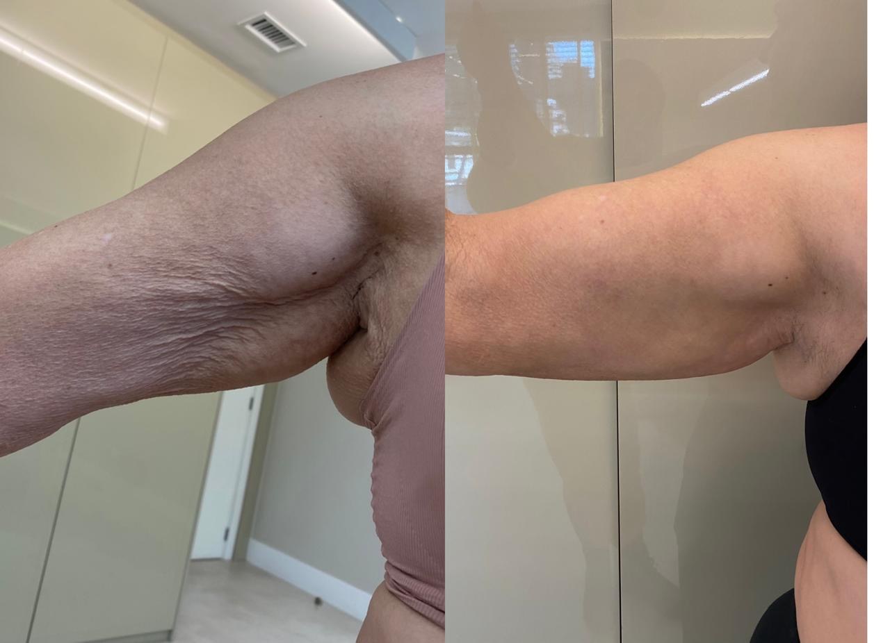 Antes e depois — Braços — flacidez