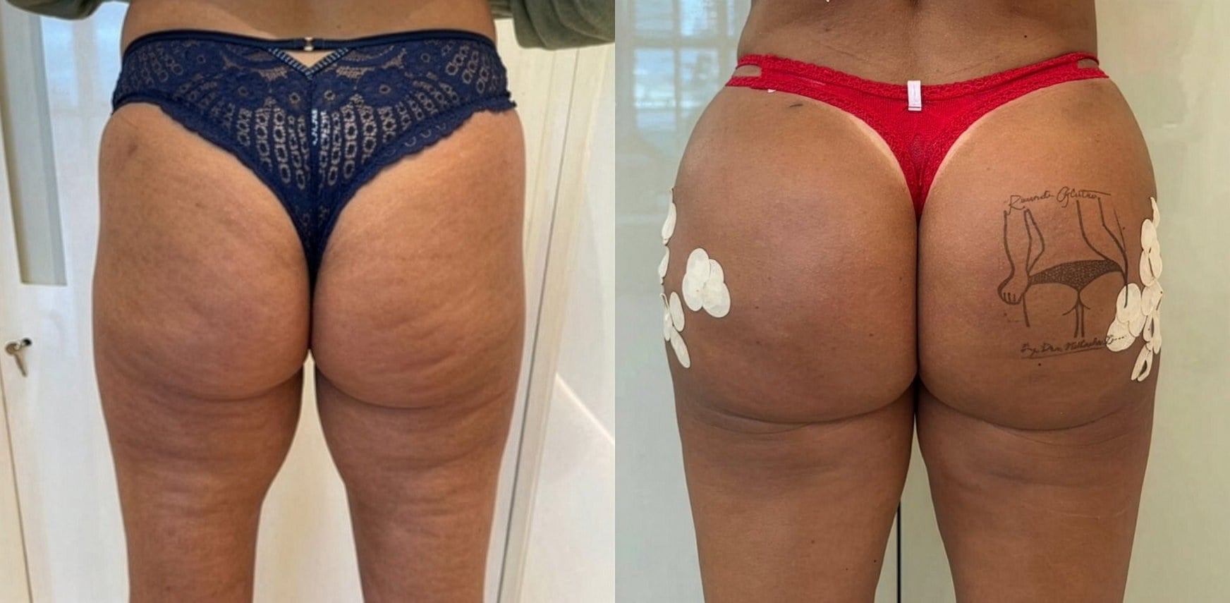 Antes e depois — Celulite e contorno
