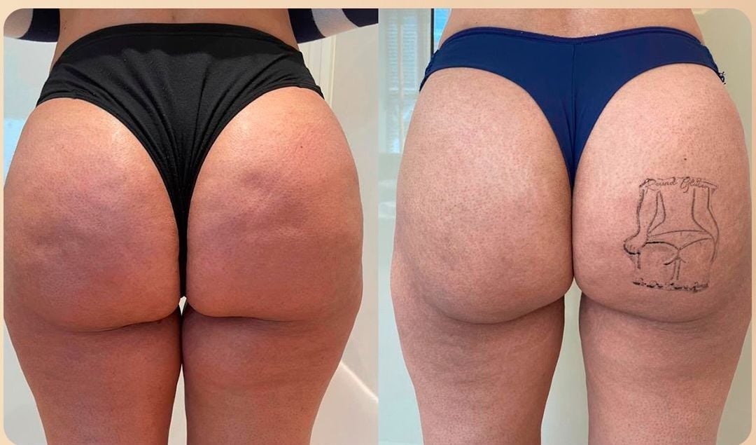 Post: caso clínico ROUNDgluteo®