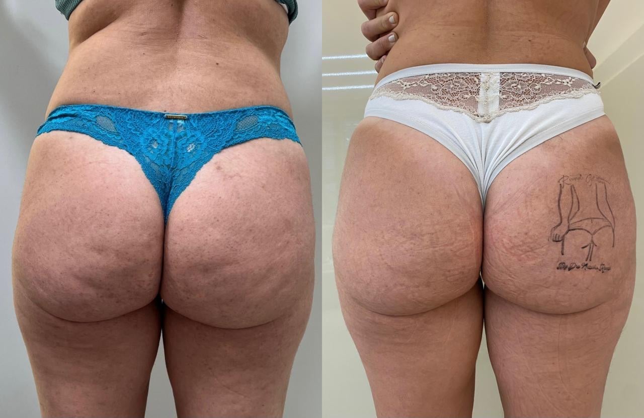 Antes e depois — Flacidez e qualidade da pele