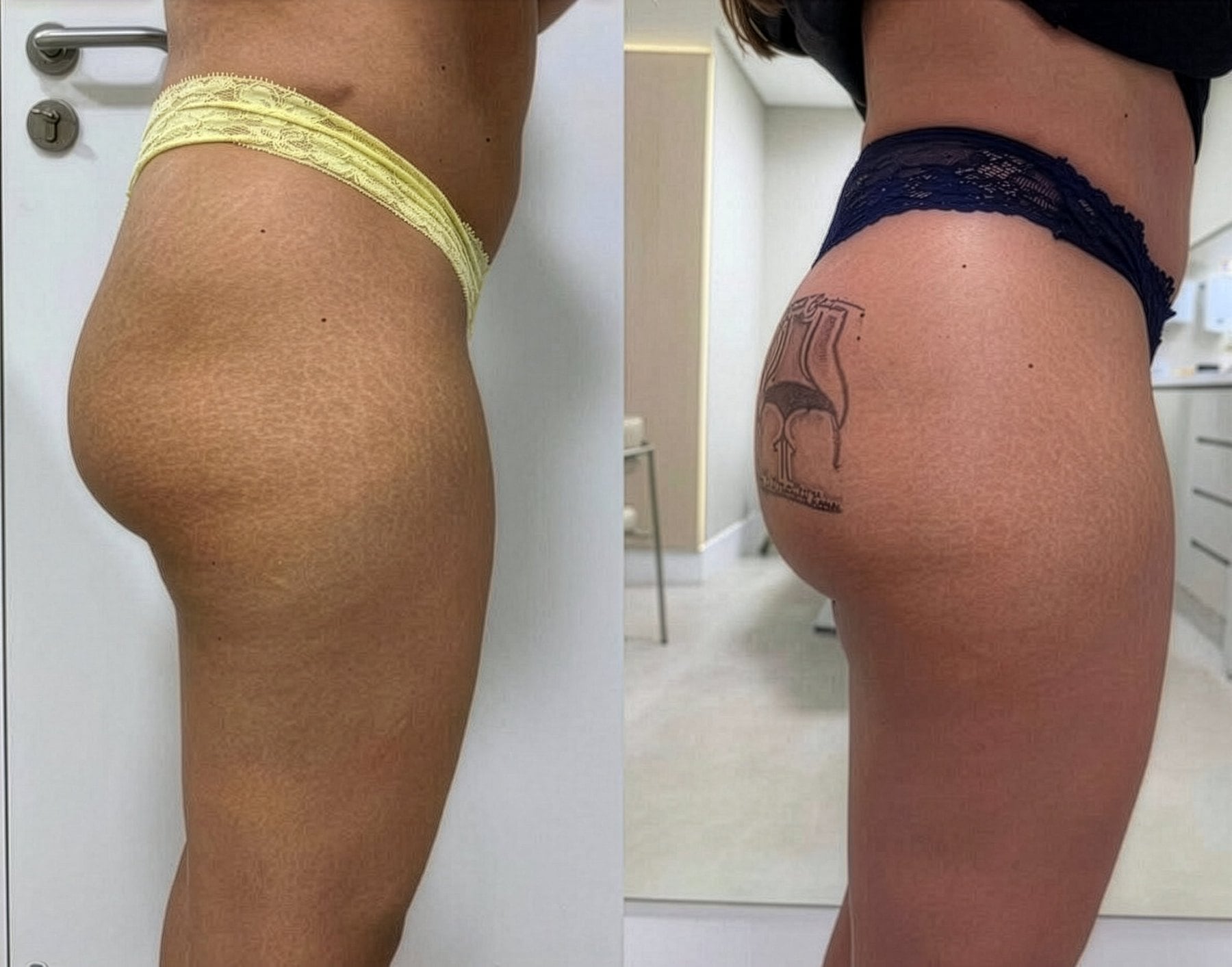 Antes e depois — Perfil e projeção