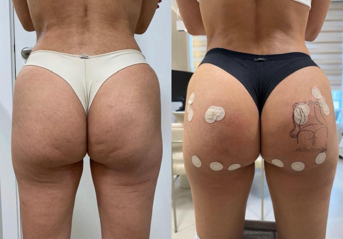 Antes e depois — Firmeza e uniformidade