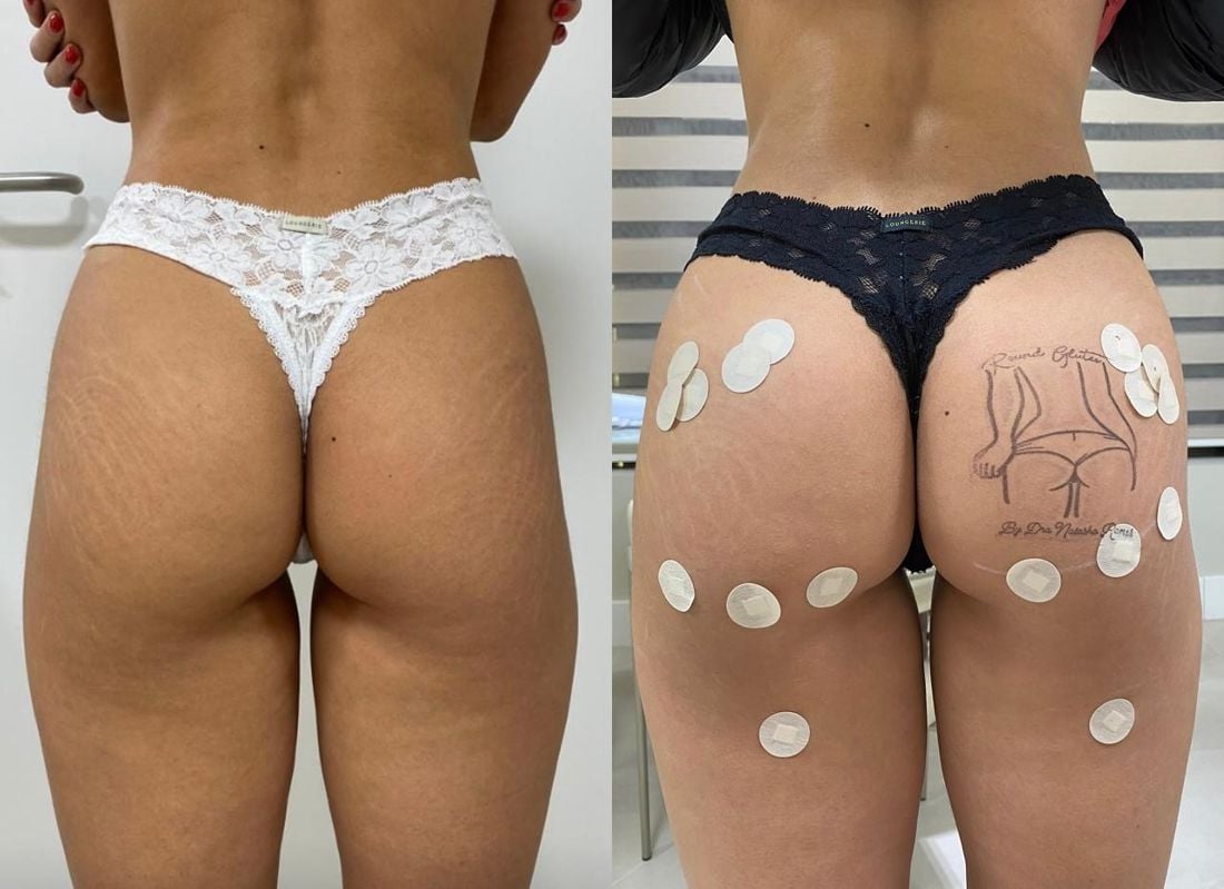 Antes e depois — Biotipo magro