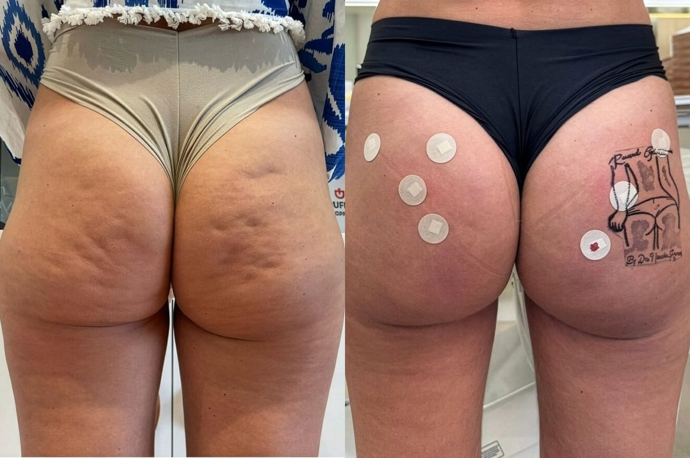Antes e depois — Textura e firmeza
