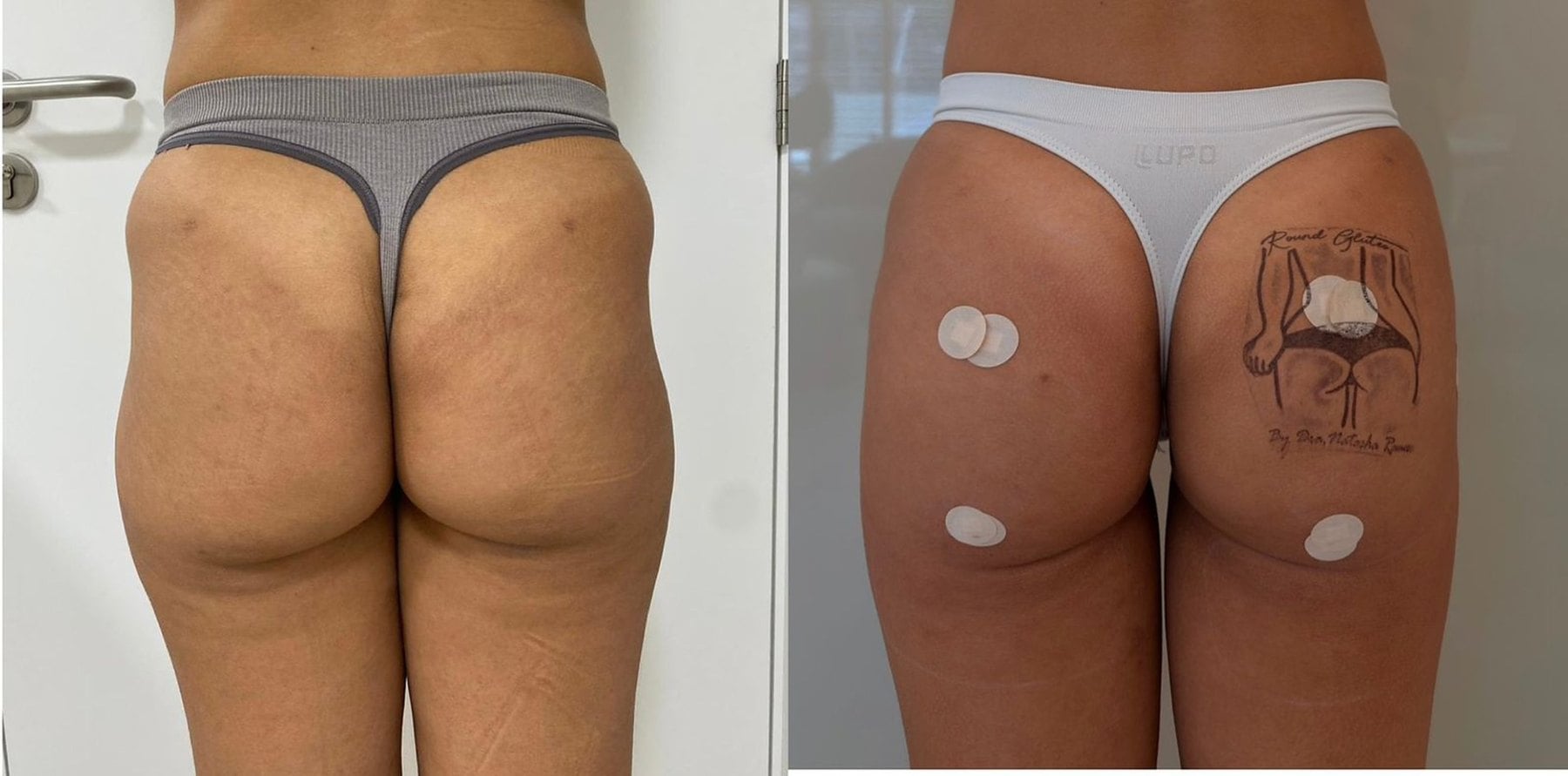 Antes e depois — Contorno e firmeza