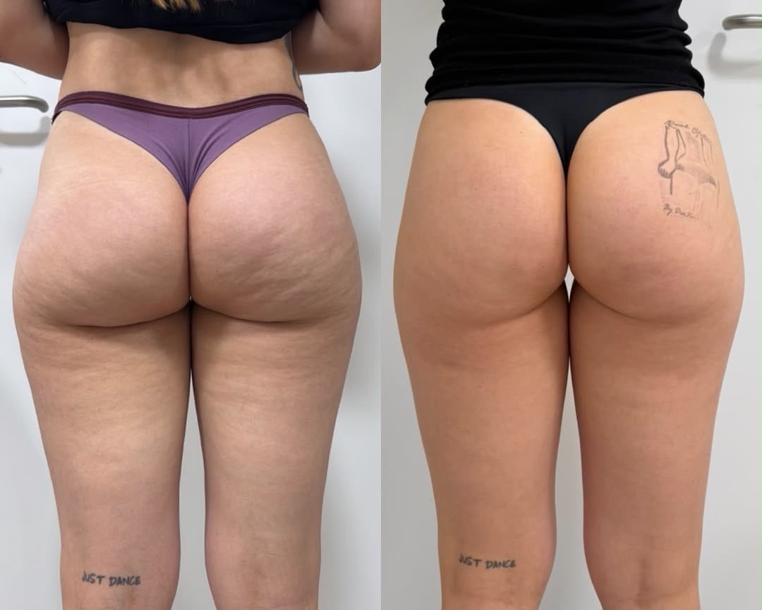 Antes e depois — Celulite e firmeza