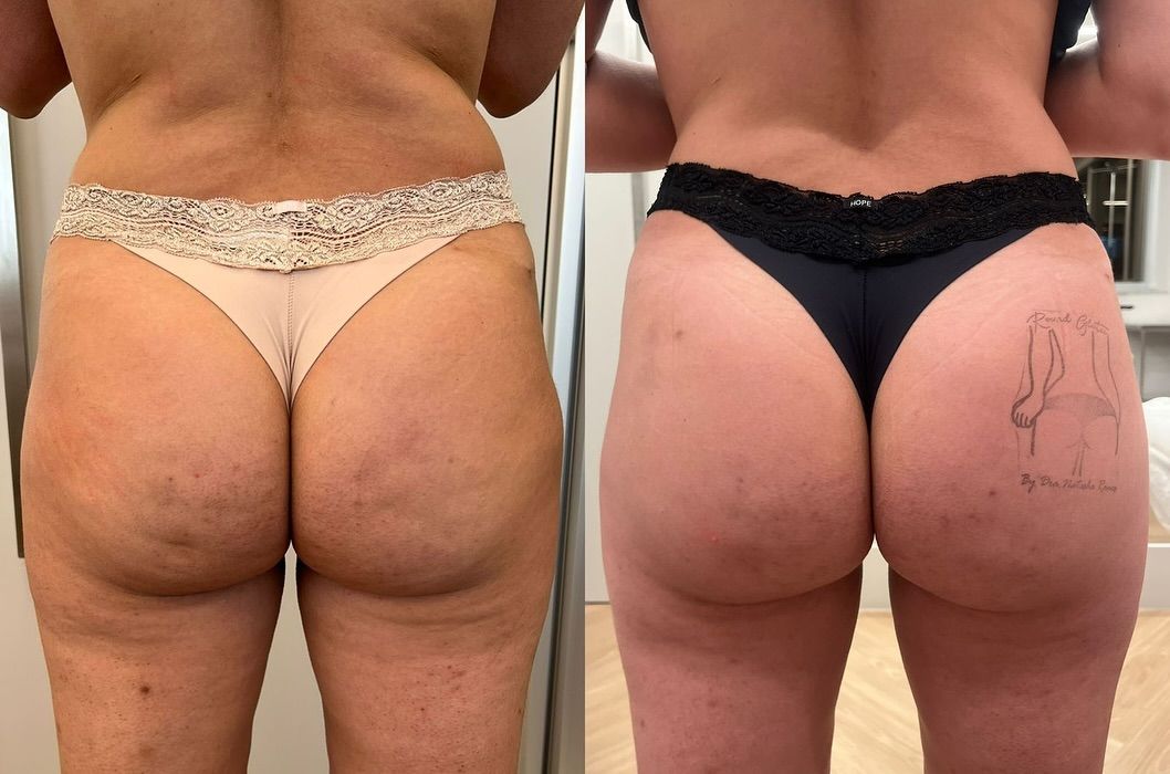 Antes e depois — Qualidade da pele
