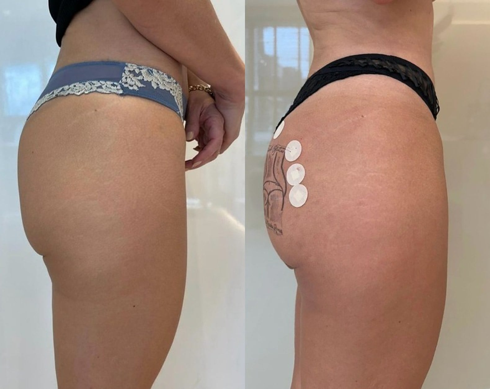 Antes e depois — Projeção lateral