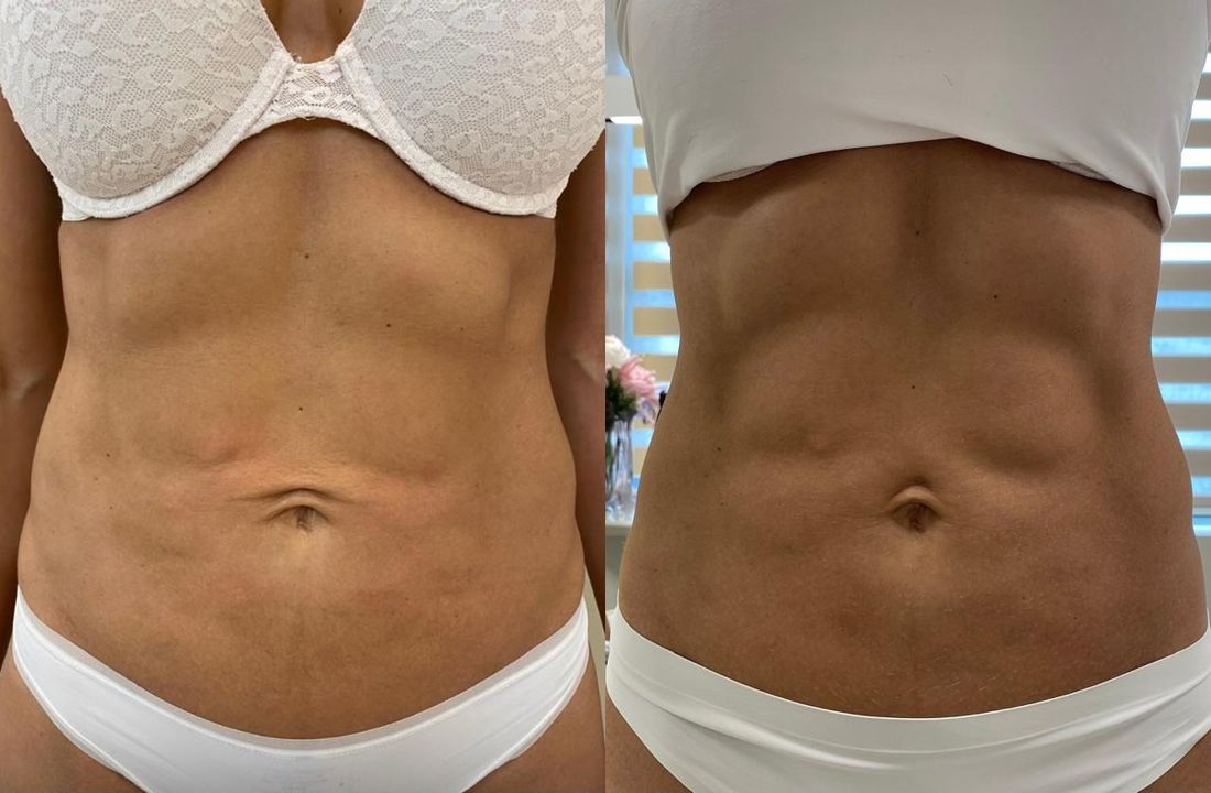 Antes e depois — Abdômen