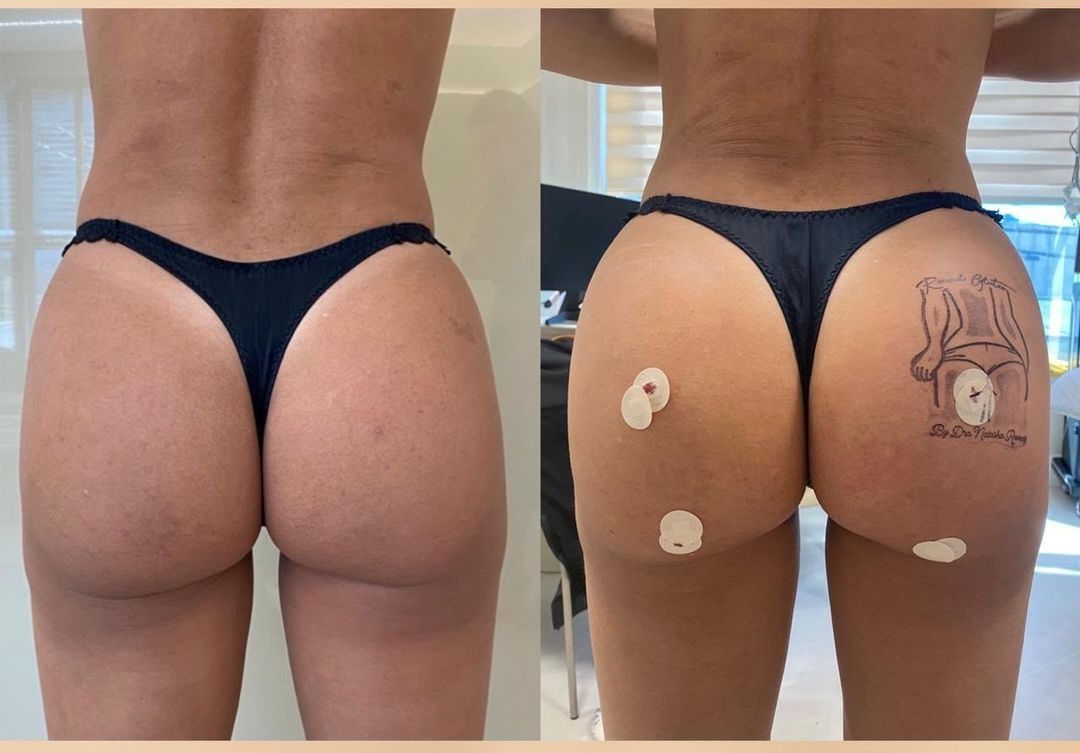Antes e depois — Contorno e sustentação