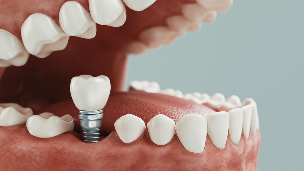 Implantes Dentários