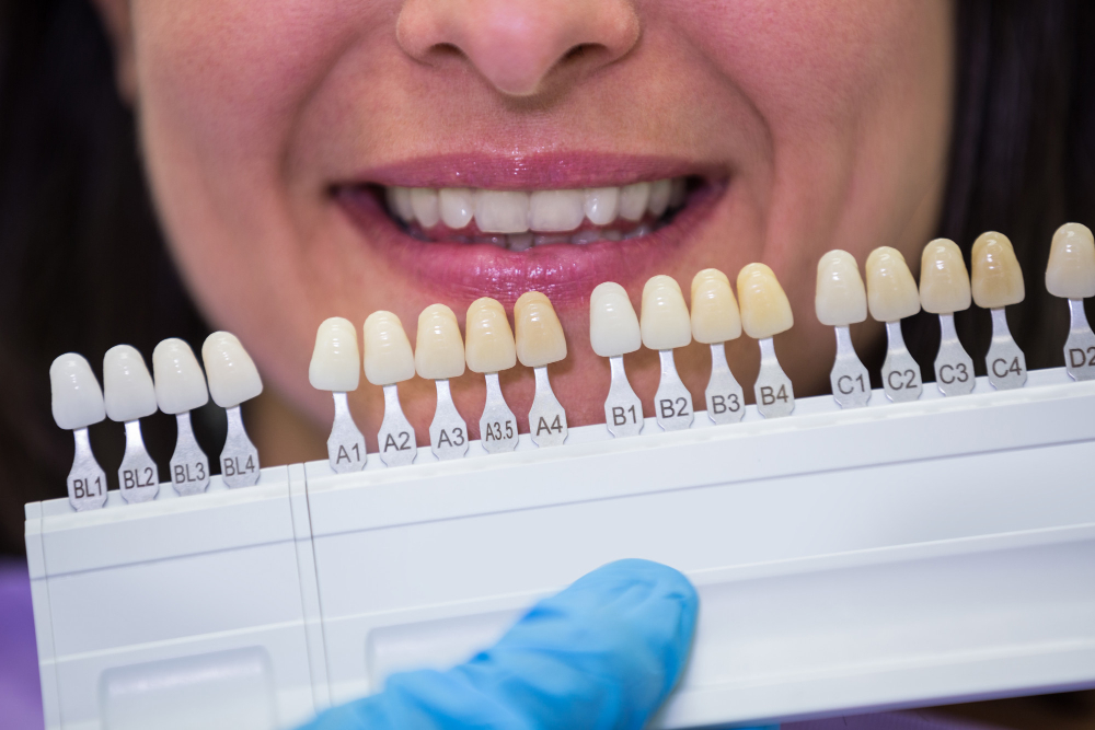 Lentes de Contato Dental